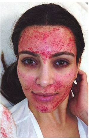 De Vampire Facelift van Kim Kardashian - Skin Academy